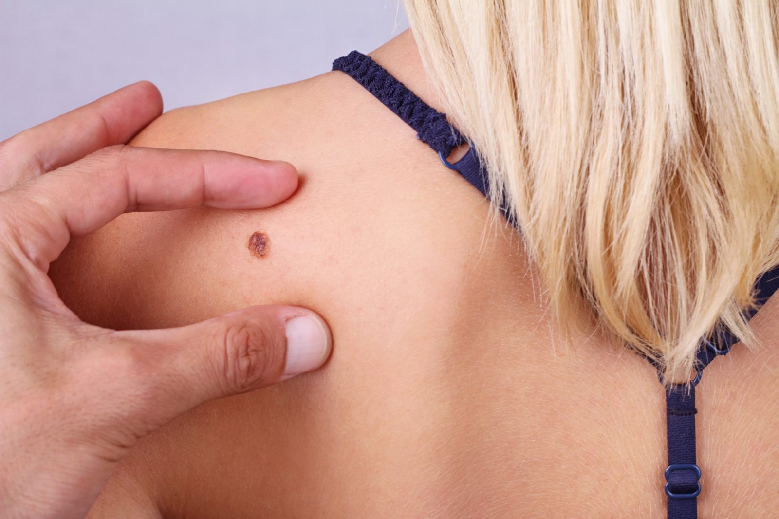 Dermatologija mi je v najstniških letih precej pomagala